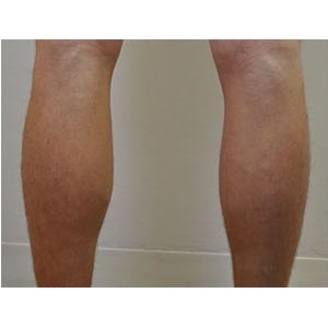 Calf Implants Calf Augmentation Sydney Calf Enhancement Sydney Large